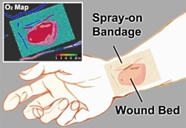 Smart Bandage Aids Wound Healing|Health Tech Insider